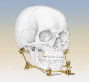 Treatment of Jaw Fracture